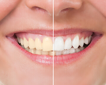 Before and after whitening